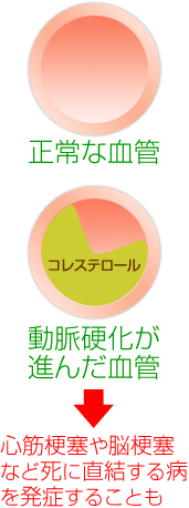 正常な血管と動脈硬化が進んだ血管